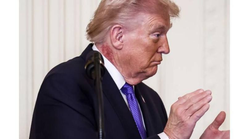 راز لکه‌های خون؛ وضعیت سلامتی ترامپ در خطر است؟